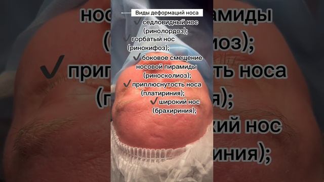 Виды деформаций носа. Какие бывают деформации носа #ринопластика #риносептопластика смотреть онлайн