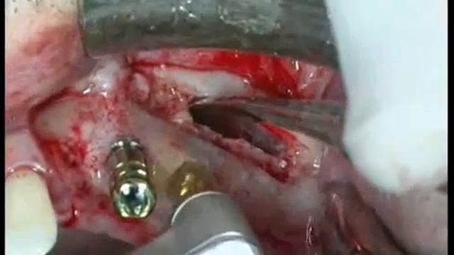 Sinus lift and TIXOS implants смотреть онлайн