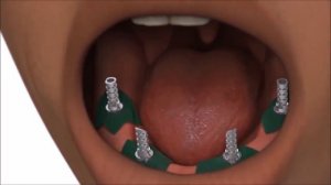 Имплантация All-on-4 в Ногинске. Демонстрационный ролик этапов протезирования на 4 имплантах