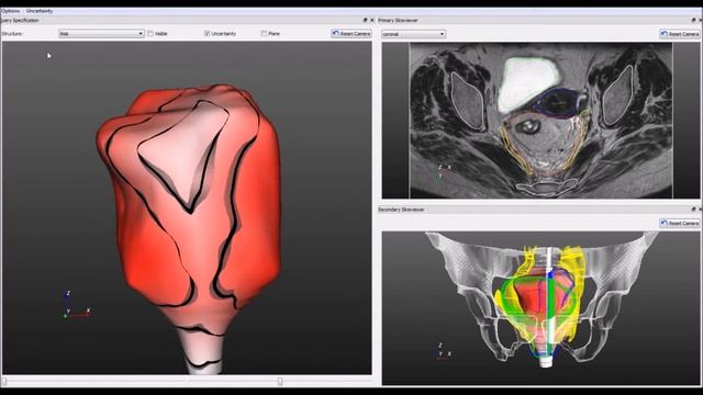 PelVis: Atlas-based Surgical Planning for Oncological Pelvic Surgery смотреть онлайн