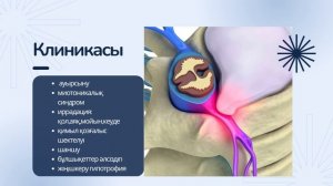 Дорсопатия - Неврология