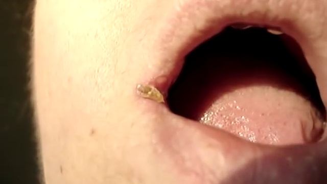 Oral Herpes Simplex ... Cold Sore #03 смотреть онлайн