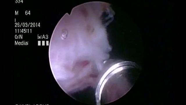 HoLEP, Part 7 - Holmium Laser Enucleation of the Prostate (HoLEP) Morcelation. смотреть онлайн