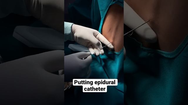 Putting a epidural catheter #mbbs #anesthesia смотреть онлайн