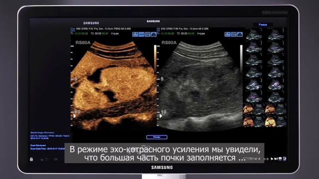 УЗИ с контрастным усилением – клинические наблюдения из клиники Гроссхарден в Мюнхене смотреть онлайн
