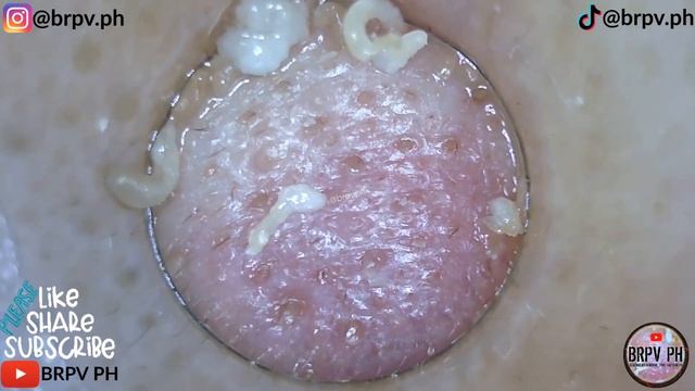 PORE VACUUM BLACKHEAD REMOVAL DEMO FOR Week-32| CLASSICAL MUSIC |@brpvph#satisfying смотреть онлайн