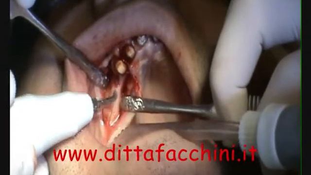 Dr.Gnalducci implantologia bifasica Mac1 e Lama con piezo смотреть онлайн