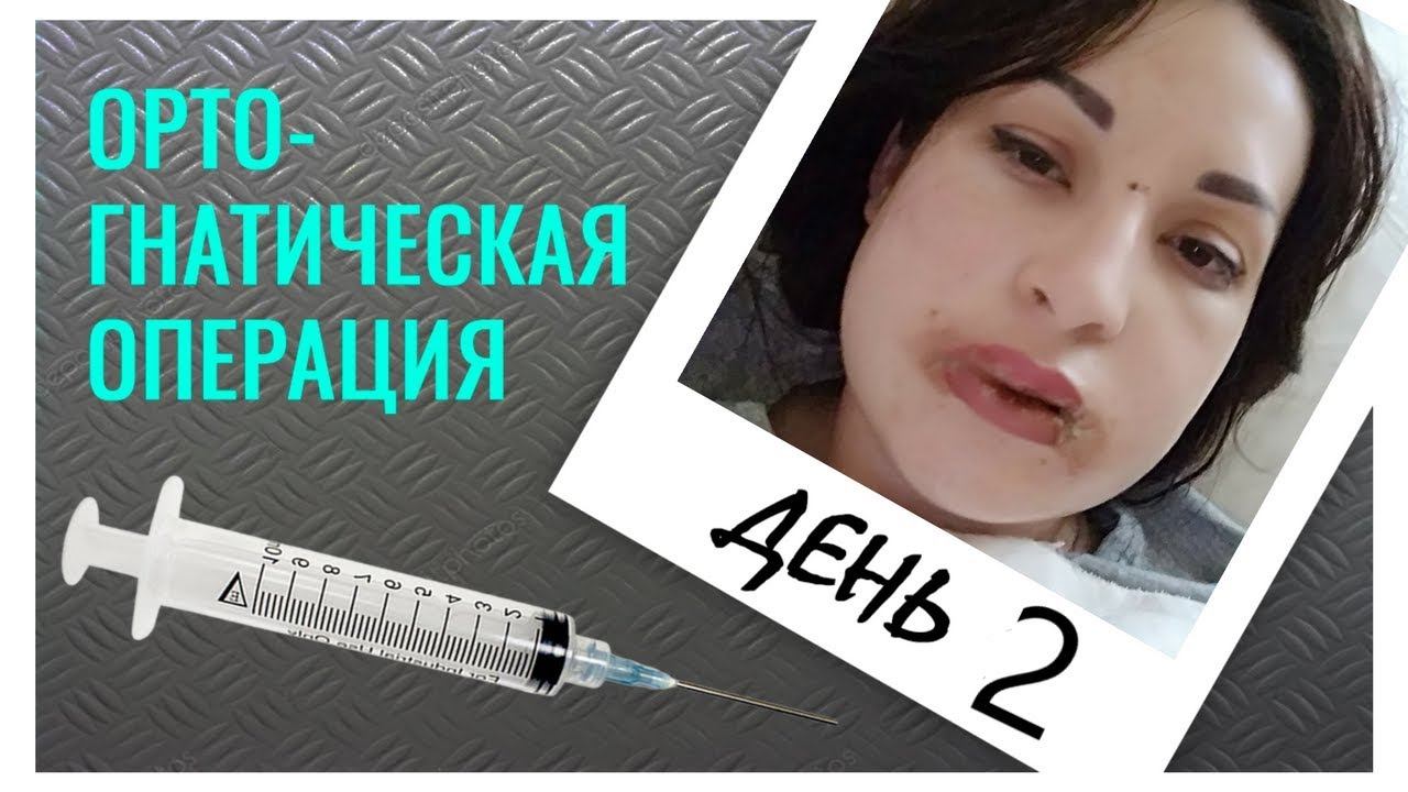 Ортогнатическая операция день 2 ЧЛХ