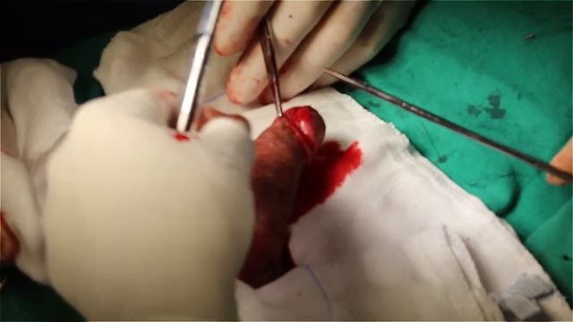 Postectomia (fimose) / Postectomy (phimosis) смотреть онлайн