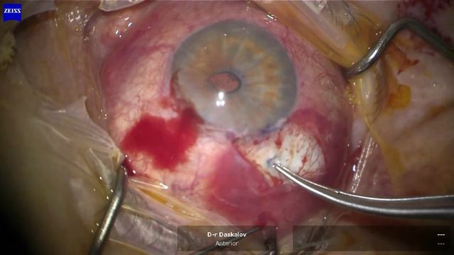PRESERFLO™ MicroShunt Device Implantation / Имплантация на PRESERFLO™ шънт за лечение на глаукома