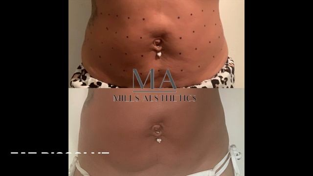 Hyaluron Pen, No Needle Dermal Filler Treatments - Brixton, London, UK смотреть онлайн