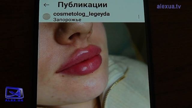Невдала спроба збільшити губи смотреть онлайн