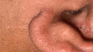 Deep Old Ear Blackhead Removal Full Video by Dr.Lalit Kasana