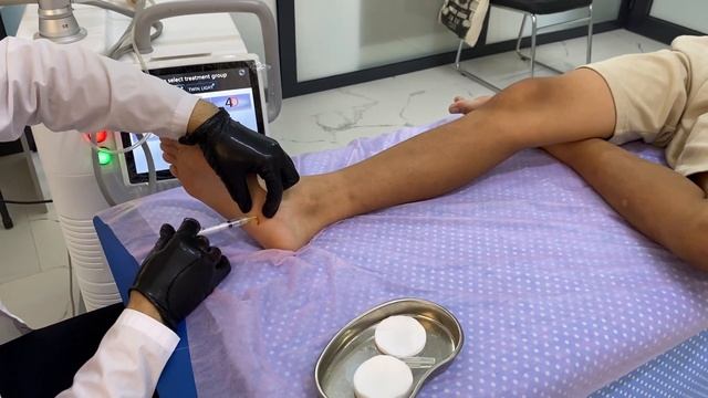 Удаляем бородавку лазером