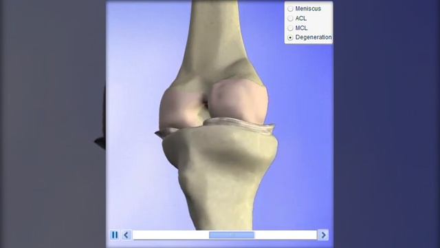 Knee Degeneration смотреть онлайн