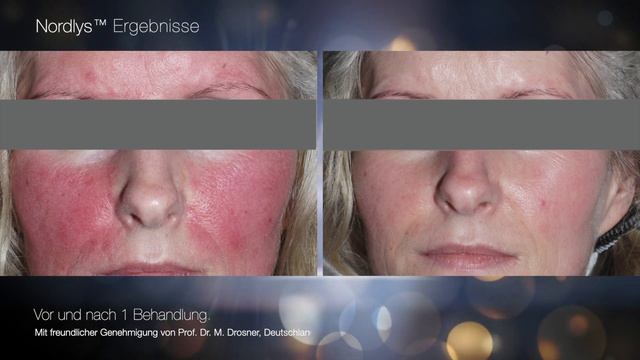Neuer Top Laser Nordlys von Candela bei JUVENIS in Wien смотреть онлайн