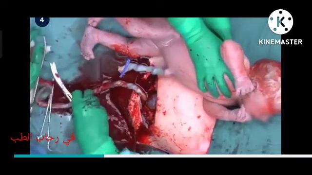 كيف تتم الولادة القيصرية ؟ how do doctors perform a caesarean delivery смотреть онлайн