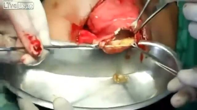 Эхинококкоз ПЕЧЕНИ не для слабонервных смотреть онлайн