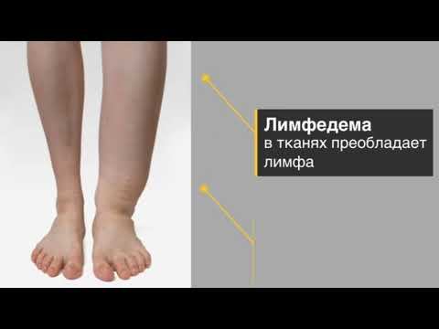 Лимфостаз смотреть онлайн