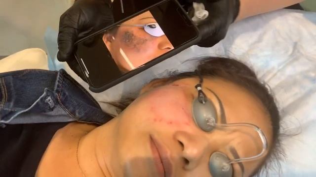 Birthmark Removal | Q-Switched Laser & Ruby Laser to the Face | West Hollywood, CA | Dr. Jason Emer смотреть онлайн
