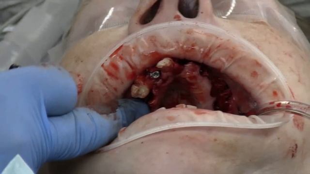 Live!! ALL-ON-4 Life Changing Surgery смотреть онлайн