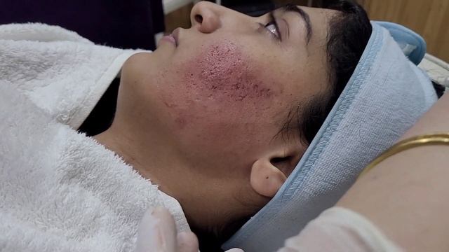 PRP Treatment for Scars ✨ смотреть онлайн