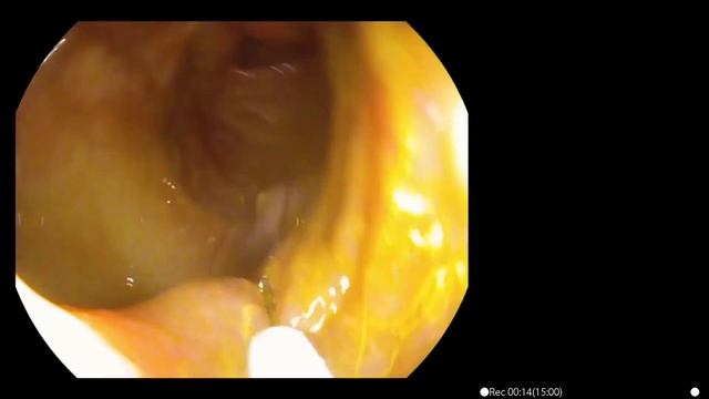 Dr Mohamed Eleview (Canada) Sessile Serrated Adenoma смотреть онлайн