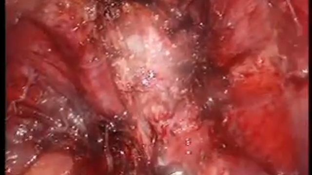 Цистопростатэктомия. смотреть онлайн