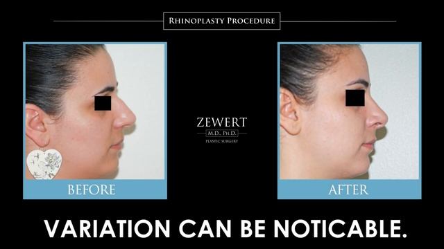 Rhinoplasty | Reshaping the Nose | Dr. Zewert M.D., PH.D. смотреть онлайн