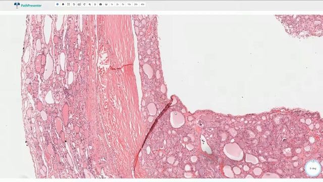Follicular Adenoma - Thyroid Gland, Histopathology смотреть онлайн