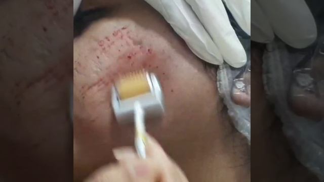 What Derma-roller does to skin? смотреть онлайн