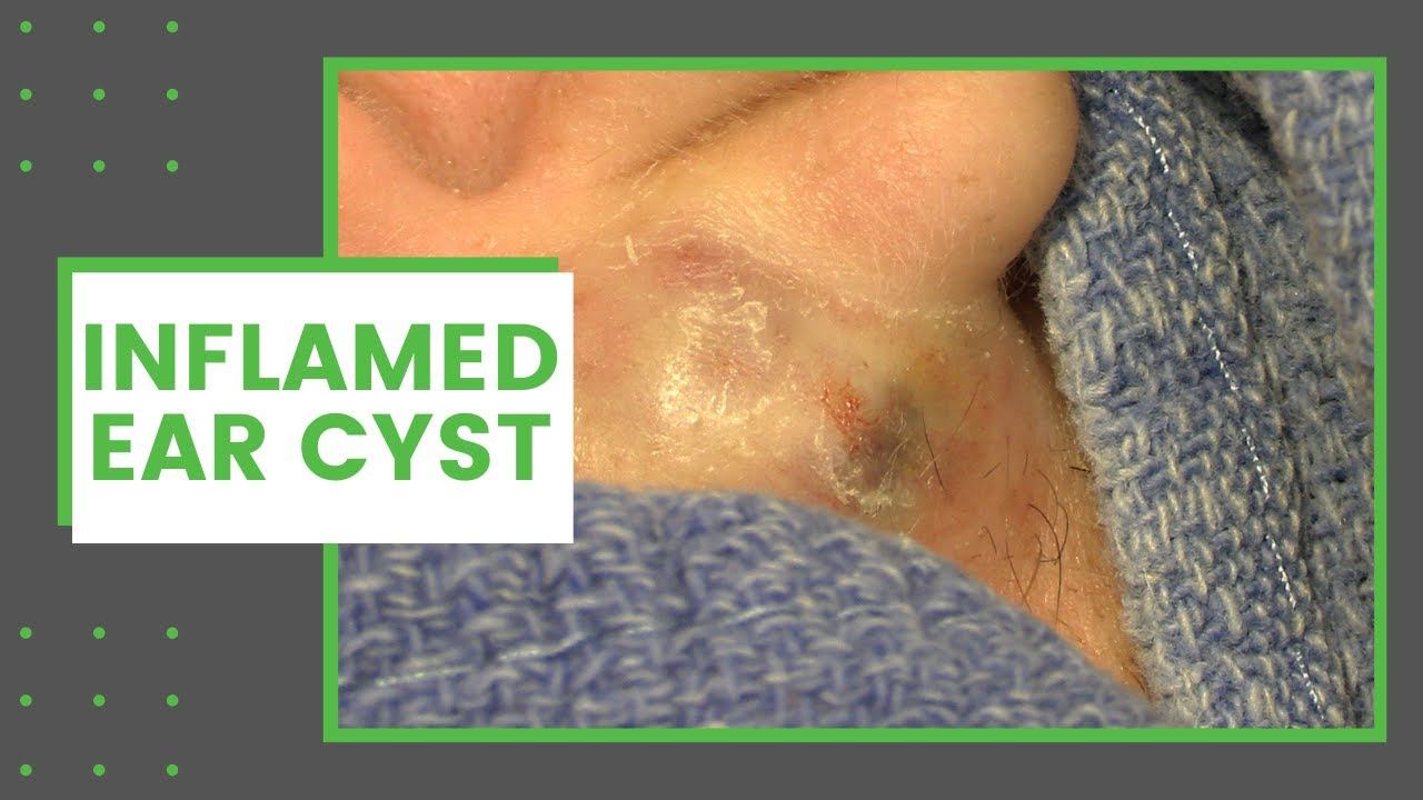 Inflamed Ear Cyst | Dr. Derm смотреть онлайн