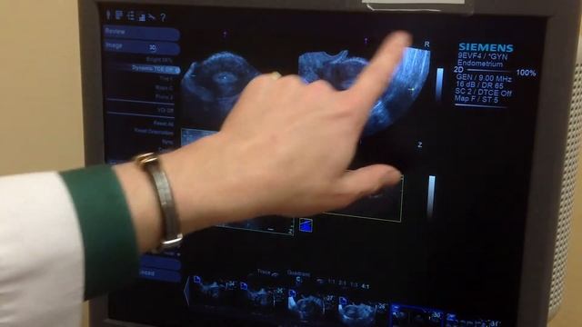 3D Pelvis Reconstruction - S-Family Siemens Ultrasound смотреть онлайн