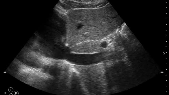 Тромбоз НПВ. IVC trombosis смотреть онлайн