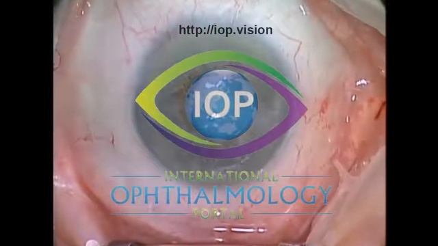 Management of Graft Astigmatism Part 1 Preview смотреть онлайн