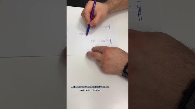 Сердце расширено на рентгене. Кардиомегалия. Точно ли оно расширено? смотреть онлайн