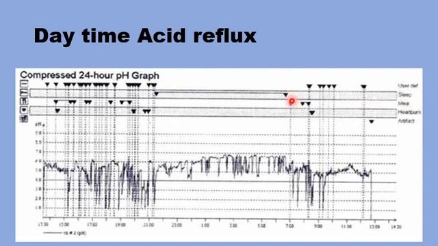 Laryngopharyngeal Reflux : Interpreting PH Impedance Monitoring
