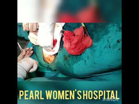 Laprotomic Myomectomy смотреть онлайн