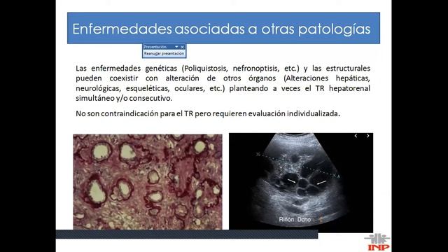 SELECCION DEL RECEPTOR EN TRASPLANTE RENAL PEDIATRICO смотреть онлайн