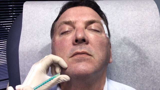 The DAO Muscle - BOTOX® Injections in Dallas смотреть онлайн