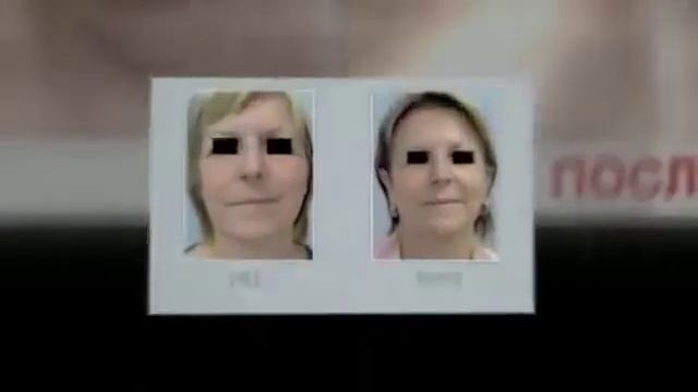 Гиалуроновая кислота до и после смотреть онлайн