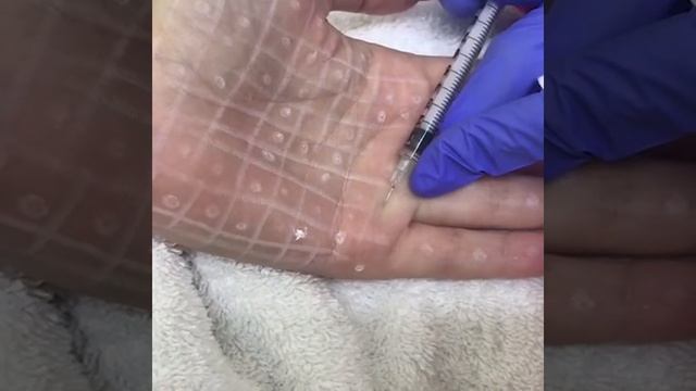 Art of Beauty Center Botox Injections for Hyperhidrosis смотреть онлайн