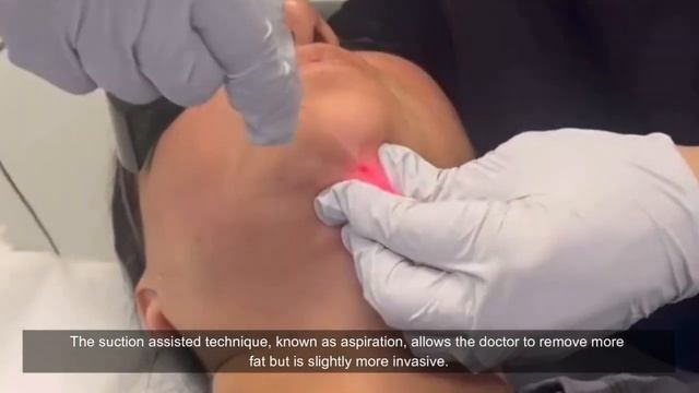 Double chin removal neck lift diode laser beauty machine-TRIANGEL MINI 60 смотреть онлайн