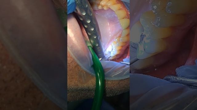 Coronas de Zirconio en Odontología y Dr Andres Suarez Lopez Protesis dental смотреть онлайн
