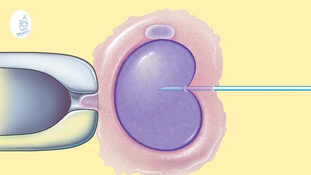 Tube Baby (IVF) in Turkey (20) Days - Turk Aesthetic смотреть онлайн
