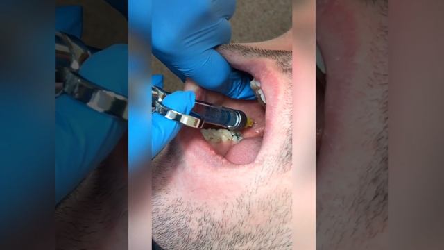 Mandibular anaesthesia Inferior alveolar nerve block (IANB)#dentist#dentistry смотреть онлайн