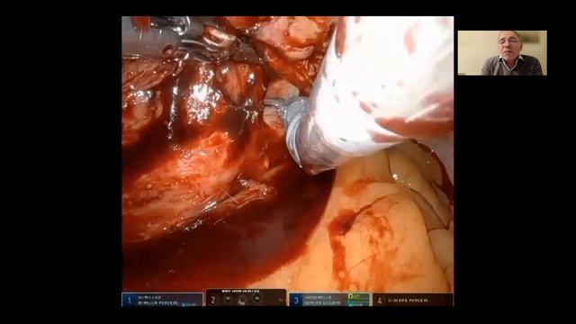 UROWebinar: Advanced robotic ureteral reconstruction смотреть онлайн