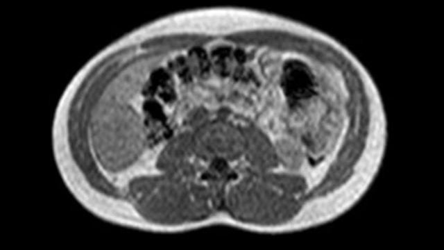 Hepatic Adenoma смотреть онлайн
