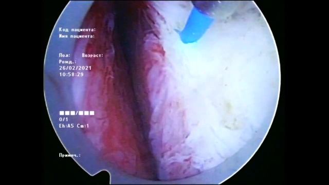 HoLEP 3 Lobe Technique Dmitry Surenkov/Гольмиевая лазерная энуклеация простаты 3-х долевая техника смотреть онлайн