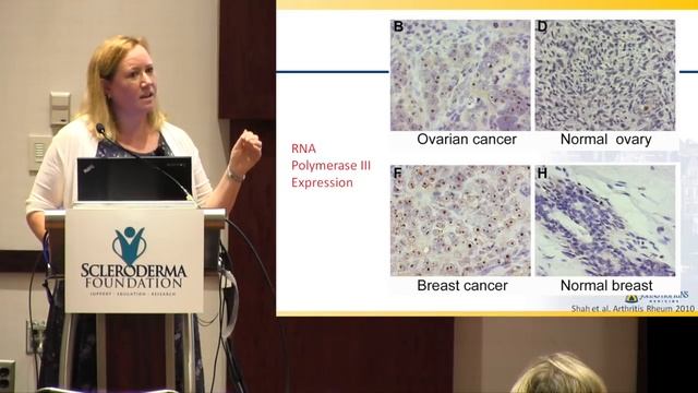 Understanding the Link Between Scleroderma and Cancer- Laura K. Hummers, M.D., Sc.M.- 2018 смотреть онлайн